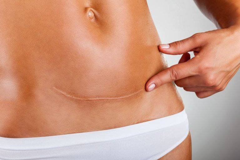 Tratamiento-de-cicatrices-con-laser-CO2-microfraccionado