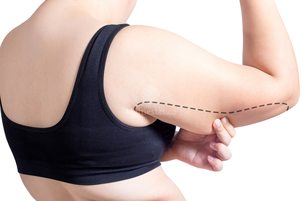 es-la-liposuccion-del-brazo-tan-efectiva-como-la-braquioplastia-0_ai1